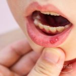 Sorridi-ch-magazine-SOS-afte-alla-bocca