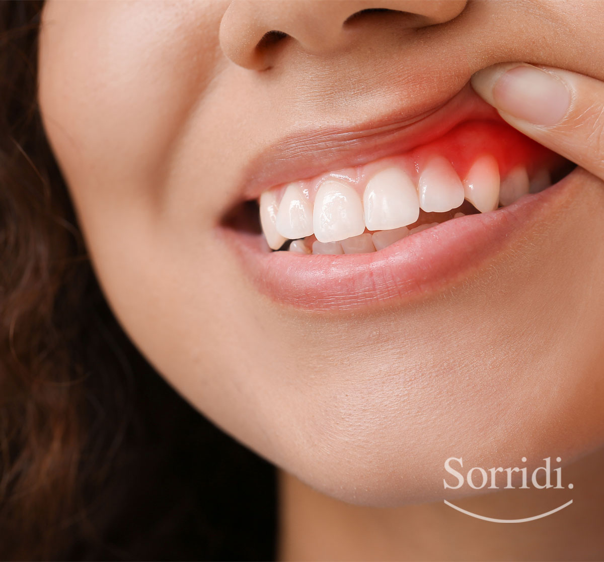 Sorridi-ch-magazine-iperplasia-gengivale
